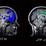 مغز و بی خوابی
