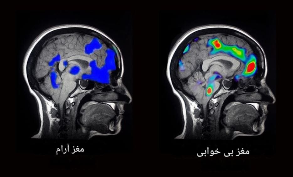 مغز و بی خوابی